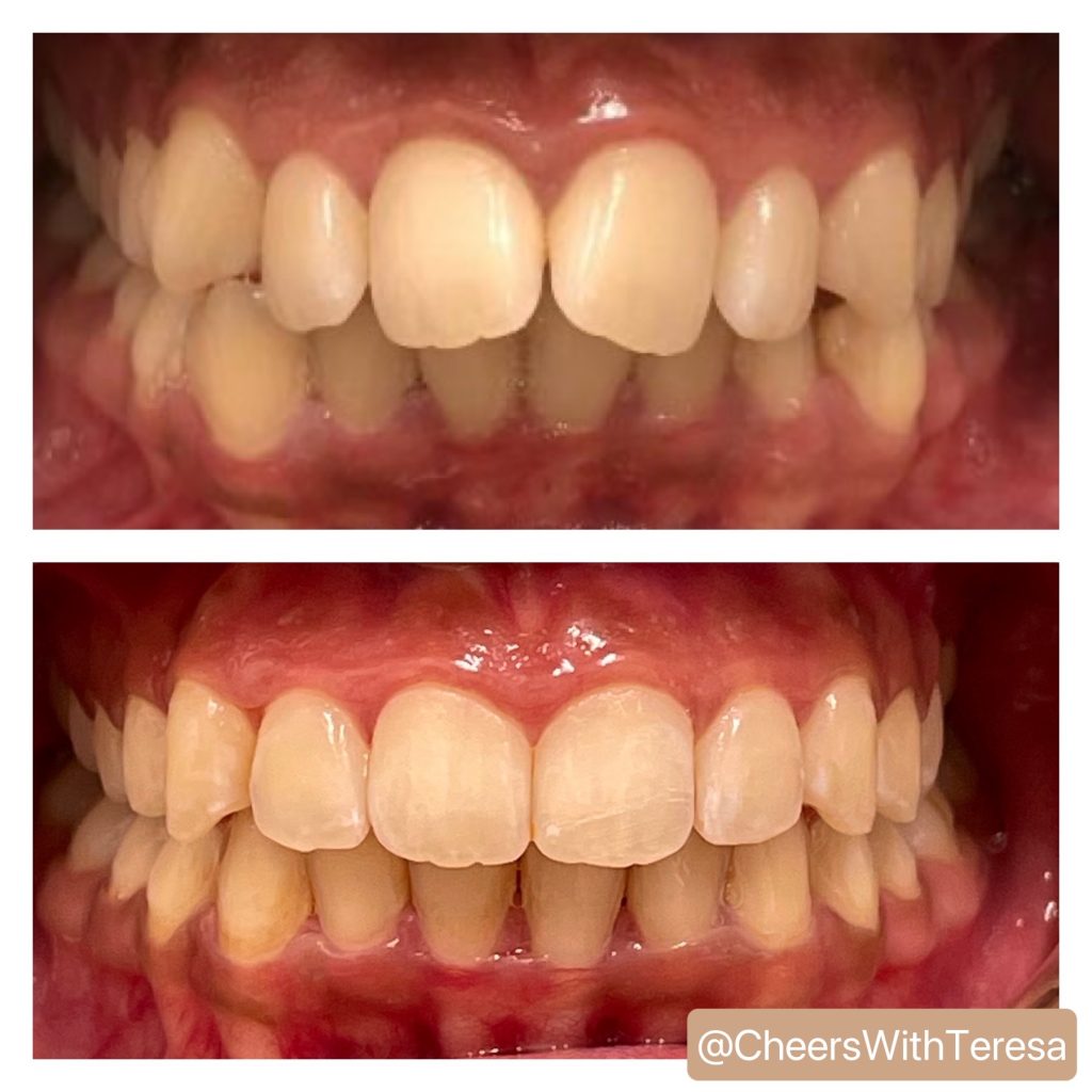 Smile transformation with Invisalign and cosmetic dentistry combination