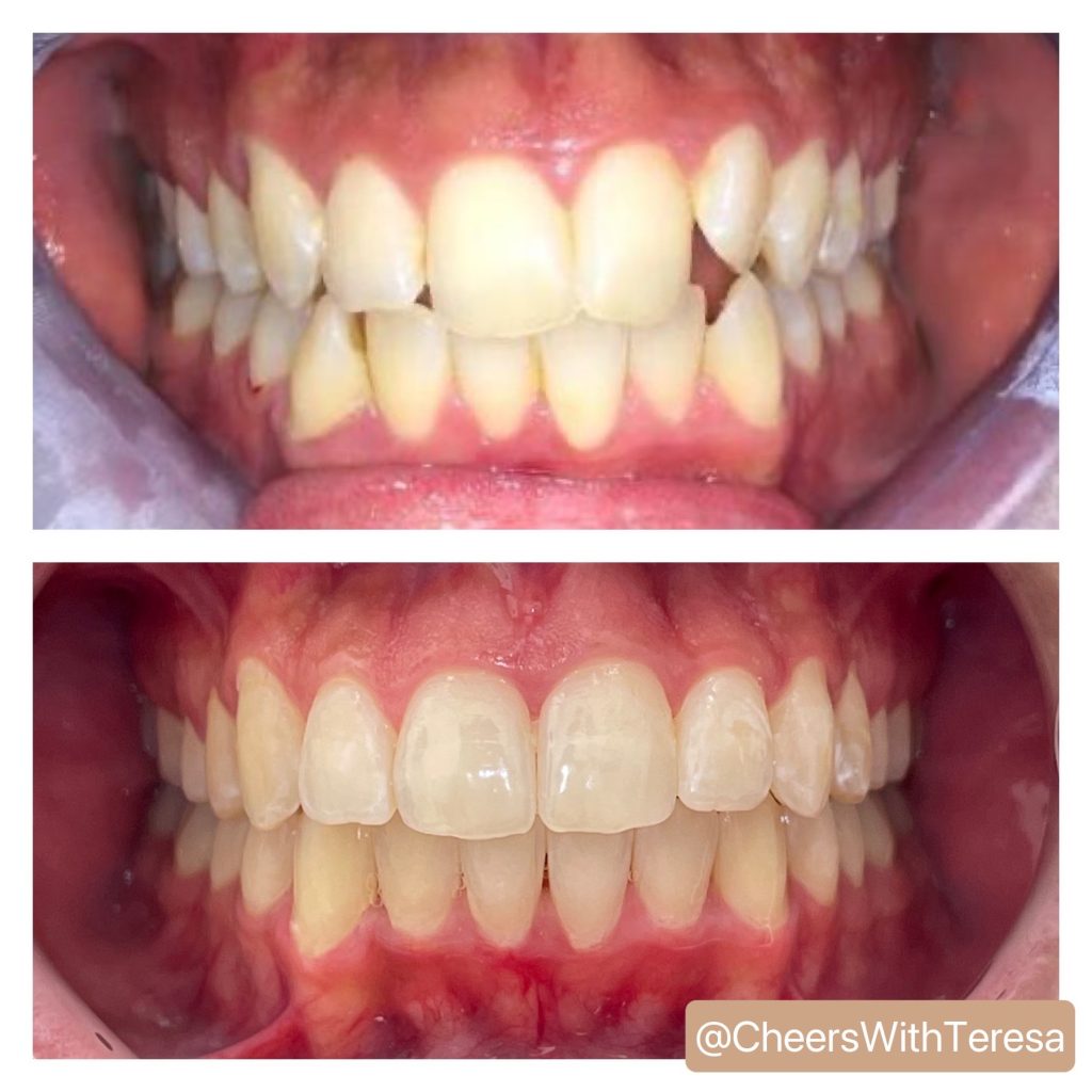 Invisalign results at Stadium Dental – teeth straightening without braces