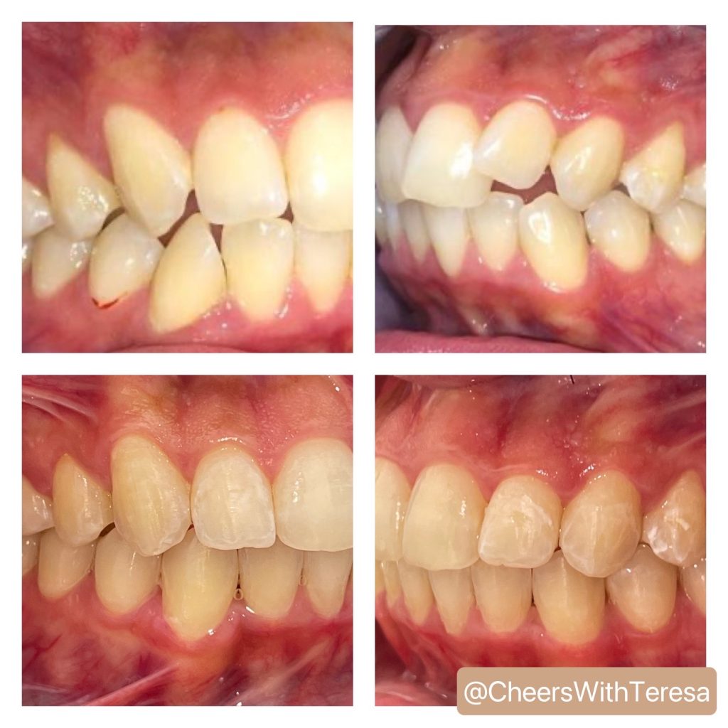 Invisalign results at Stadium Dental – teeth straightening without braces