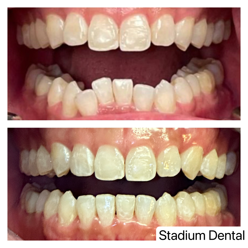 Smile transformation with Invisalign and cosmetic dentistry combination