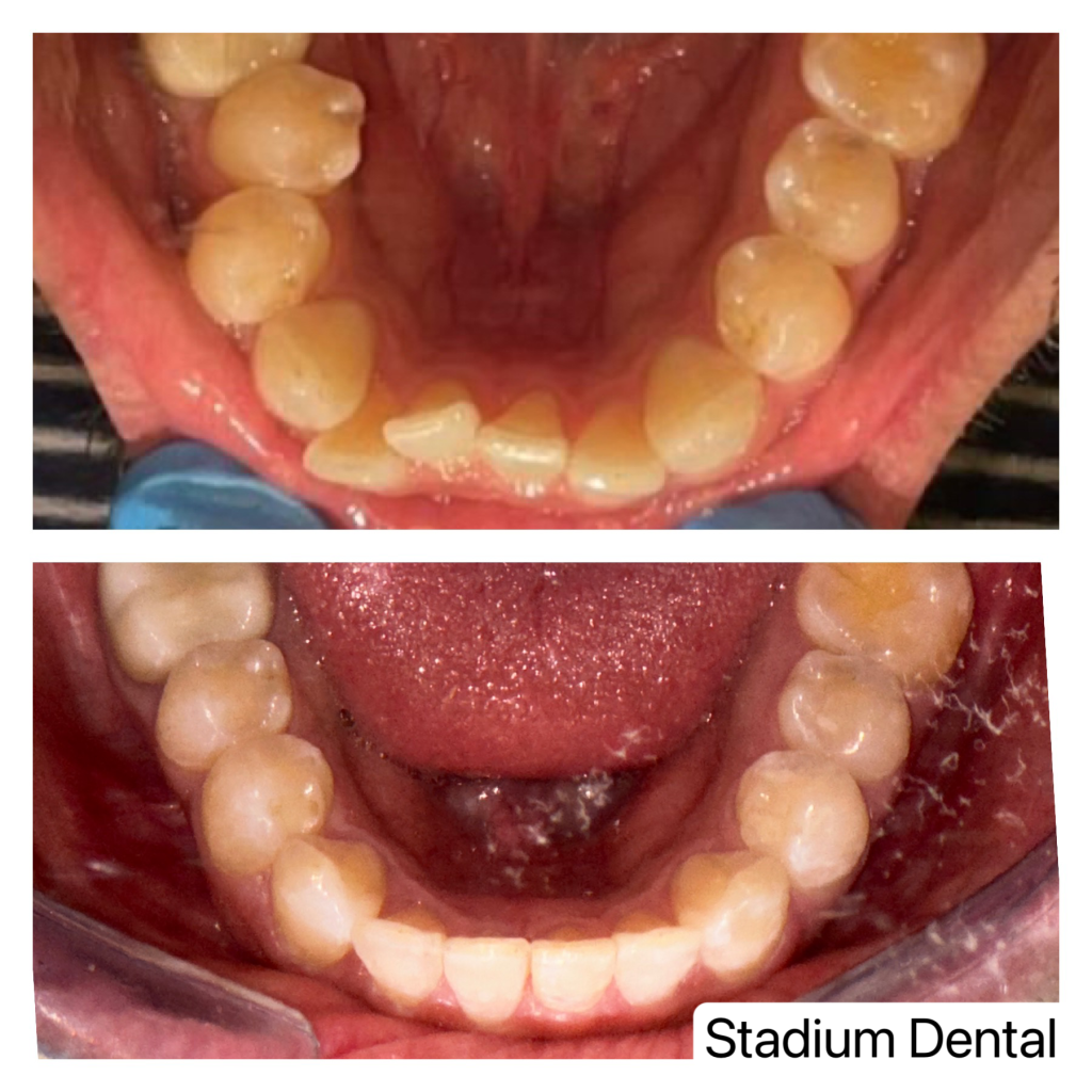 Invisalign results at Stadium Dental – teeth straightening without braces