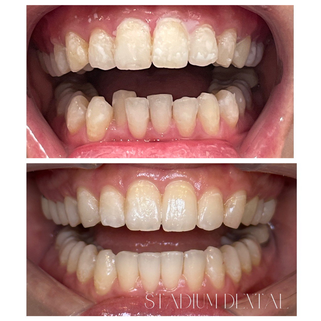Smile transformation with Invisalign and cosmetic dentistry combination