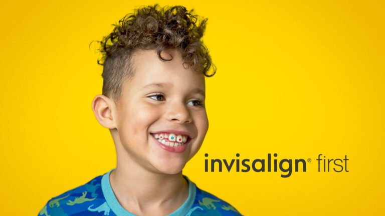 Invisalign First aligners used for jaw expansion in young child
