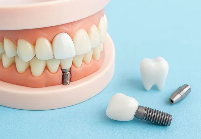 types of dental implants