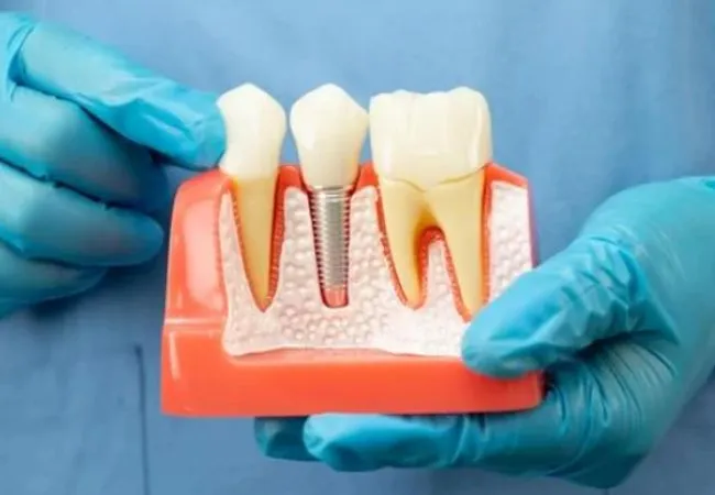can dental implants get cavities