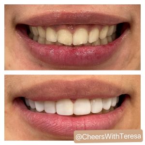 smile-design-before-after