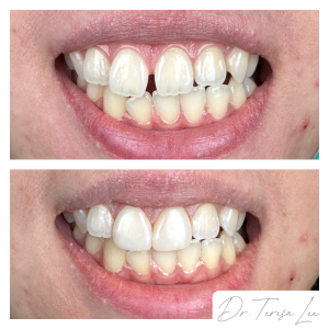 smile-design-bioclear