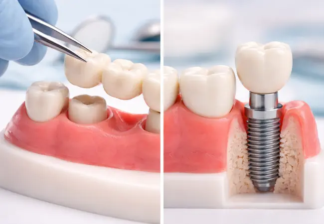 dental bridge vs. implant