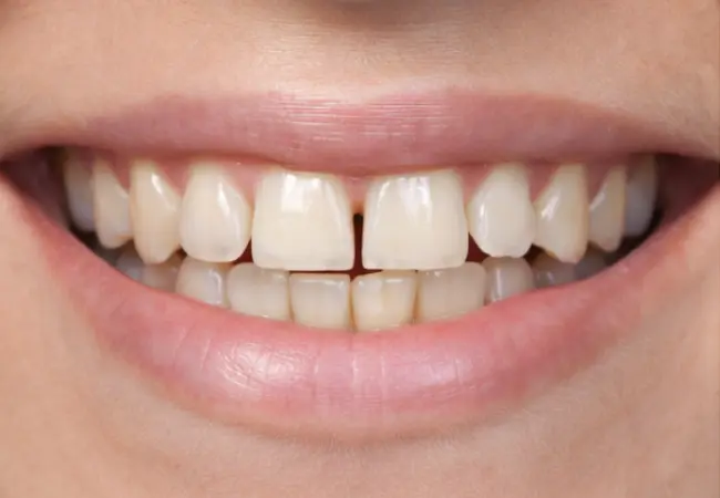 get rid of gaps between teeth