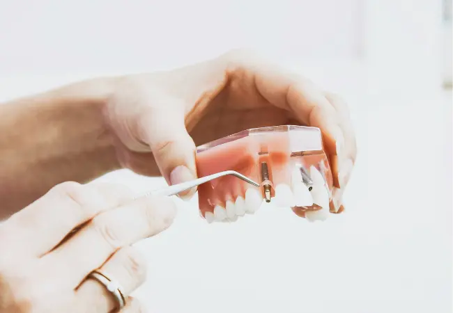all-on-4 dental implants in Vancouver