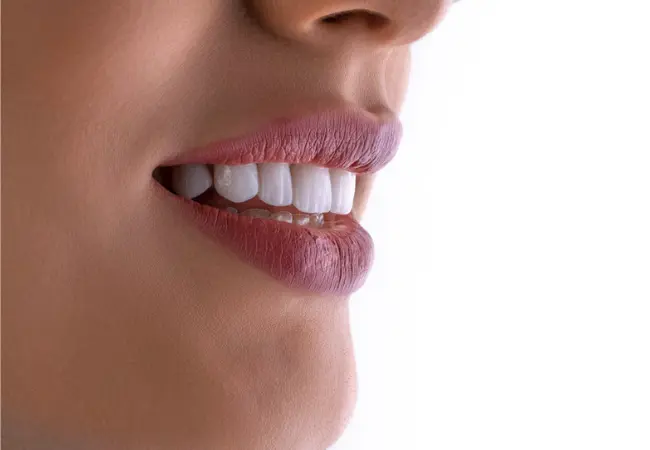 porcelain veneers in vancouver