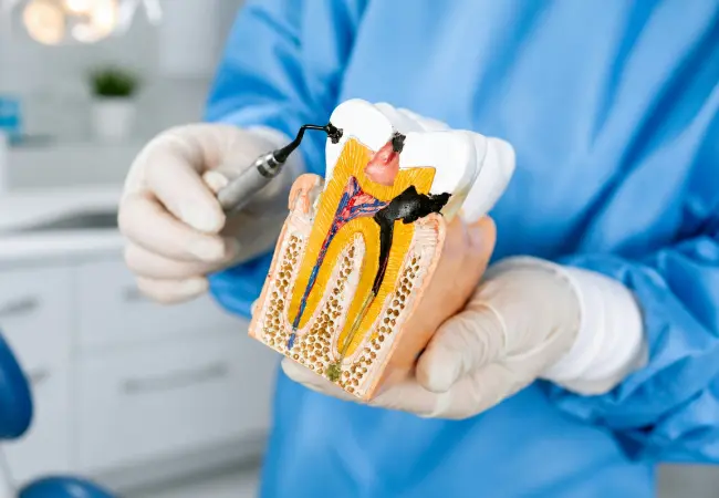 root canal treatment in vancouver